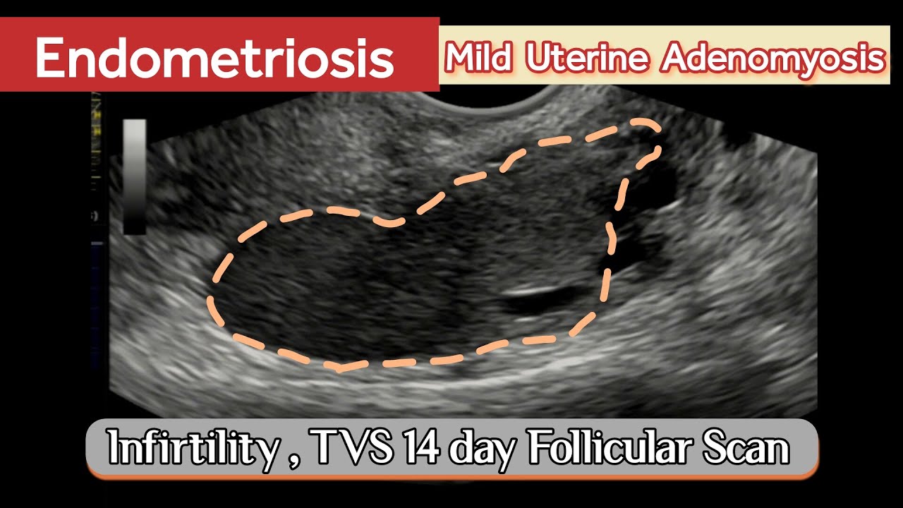 TVS Ultrasound Endometriosis Follicular Study Scan Small Follilces
