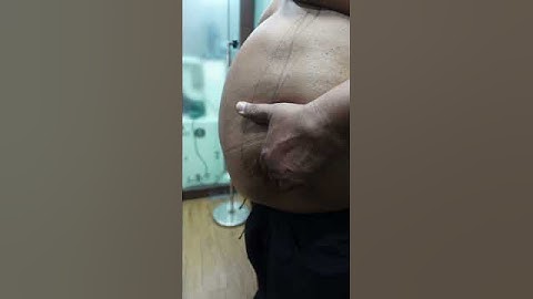 360 Abdominal Liposuction | Liposuction #short #shortvideo #shorts
