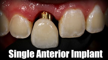 Make Perfect Central Anterior Single Implants