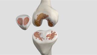 Total Knee Replacement Patient Animation