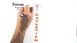 The Science of 'Plan B' - Emergency Contraception