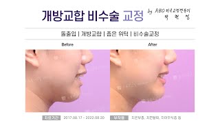 [해운대교정치과 장산 뉴욕스마일치과] 개방교합 비수술교정(돌출입/개방교합/좁은위턱/비수술교정) B&amp;A :: 해운대우동치과, 해운대중동치과, 해운대좌동치과