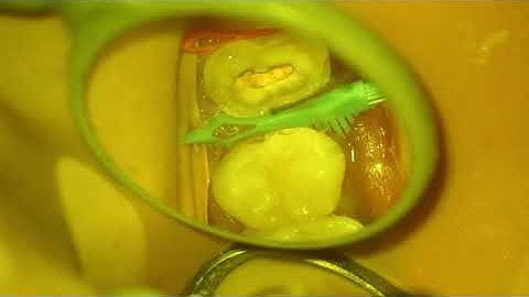 deep marginal elevation using diamond wedge