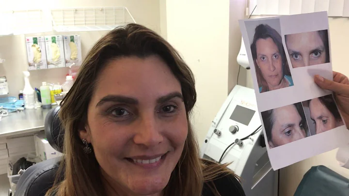 Eyebrow Transplant Result at 7 months- Patient of Dr. Epstein. - DayDayNews
