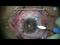 Opration de la cataracte trs mauvaise dilatation avec rtracteurs iriens