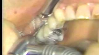 Root Amputation