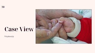 Polydactyly With Some Deviation