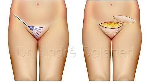 O que é lipoaspiração pubiana?