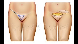 Redução do Monte de Vênus, Pubis, Gordura da Vagina, Lipo Pubiana ...
