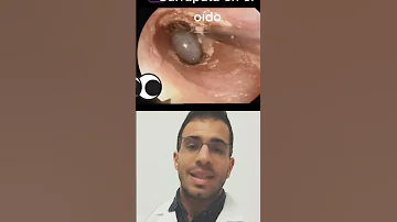 ¿Cómo es el gusano que uno tiene en el oído?