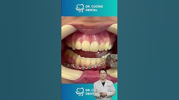 Quá Trình Yêu Thích Của Nha Sĩ Khi Tháo Niềng Răng |Dr Cường Official