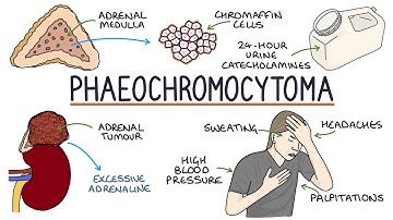 Phaeochromocytoma - A Visual Explanation For Students