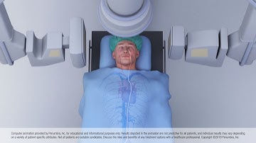 Animation of Thrombectomy Using Aspiration