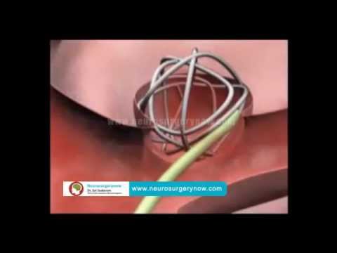 Cerebral Aneurysm Repair In Hyderabad | Aneurysm Coiling Surgery In India