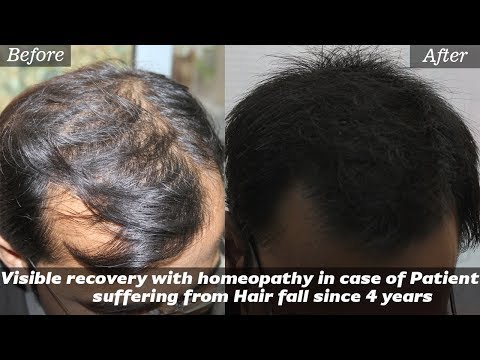 Homeopathic Treatment For Hairfall or Alopecia Problem  By Dr Shreyas  Bansal  Lybrate