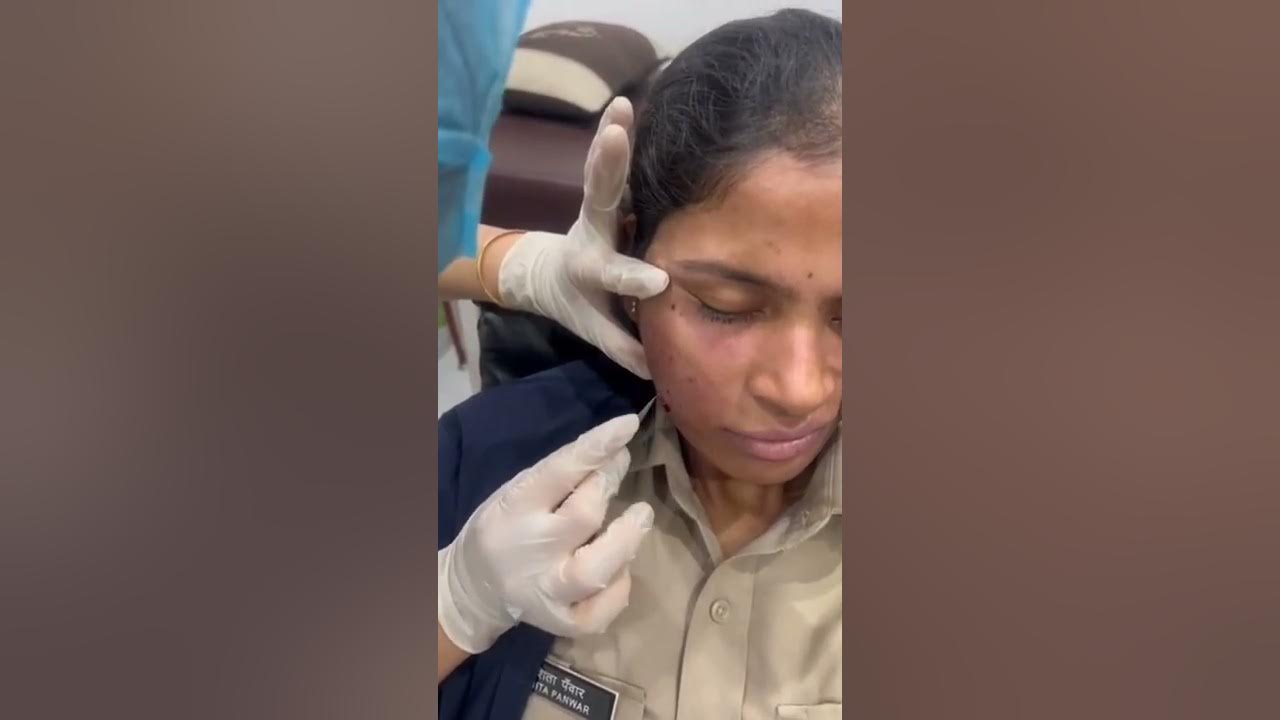 Face cupping on Girl for acne and pimples healingwithhijama1970 YouTube