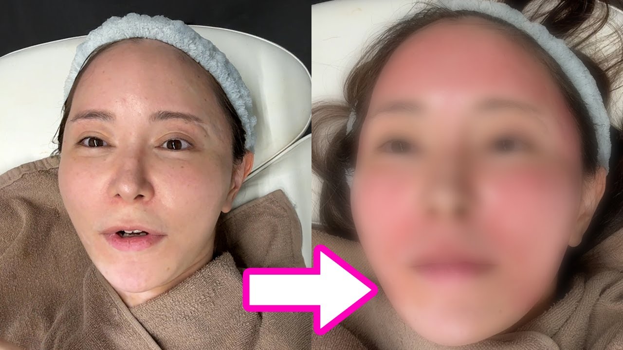 【美容整形】大量出血覚悟で数年ぶりのダーマペン。