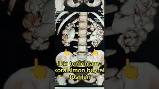 BUYRAK TOSHI #music #youtubeshorts #ytshorts #youtube #trending #trendingshorts #funny ##urology