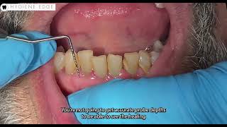 Take your probe depths AFTER periodontal therapy by Hygiene Edge 2,161 views 1 month ago 46 seconds