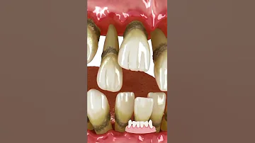 ¿La periodontitis es para siempre?