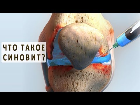 Что такое синовит и как он лечится?