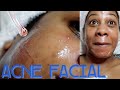 THIS REDUCES YOUR PIMPLES INSTANTLY! Full Facial for Acne Prone Skin | Esthetician Visit