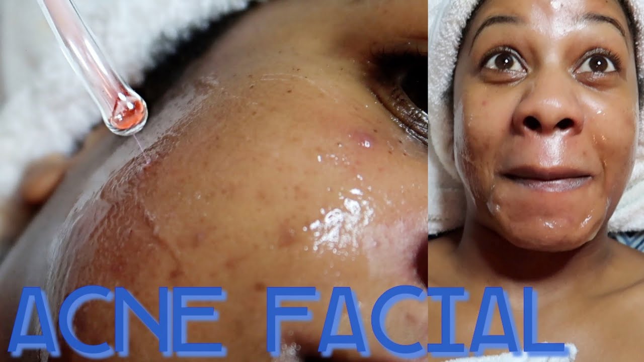THIS REDUCES YOUR PIMPLES INSTANTLY! Full Facial for Acne Prone Skin Esthetician Visit YouTube