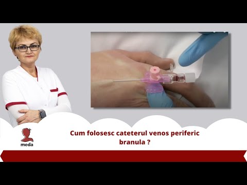 Video: Cateter Suprapubic: Inserție, Procedură și Complicații