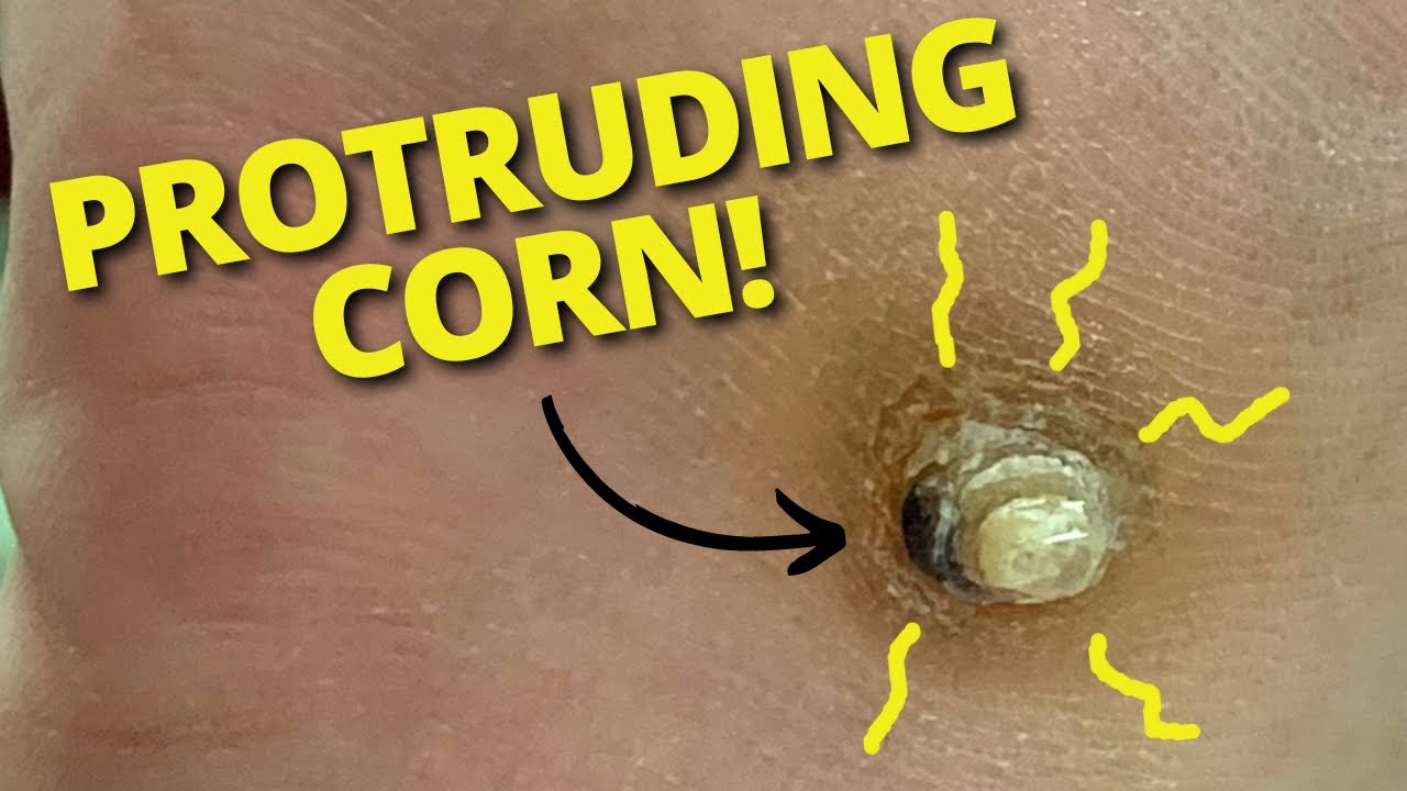 SATISFYING Corn Removal From Foot! Did Rheumatoid Arthritis Cause This ...