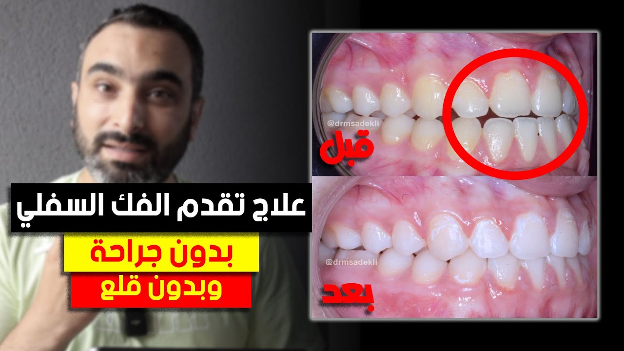 شاهد طريقة لعلاج تقدم الفك السفلي بدون قلع وبدون جراحة وفي جلسات قليلة !!