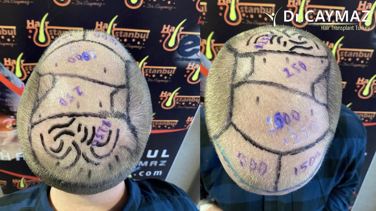 Mr Brandon 5500 Graft  Review 5 Months Sapphire Fue Technique