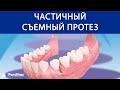 Частичный съемный протез ©