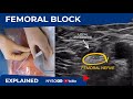 Ultrasound-Guided Femoral Nerve Block - Regional anesthesia Crash course with Dr. Hadzic