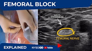 Ultrasound-Guided Femoral Nerve Block - Regional anesthesia Crash course with Dr. Hadzic