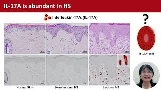 IL-17A+ mast cells in HS, C-B Chu et al.