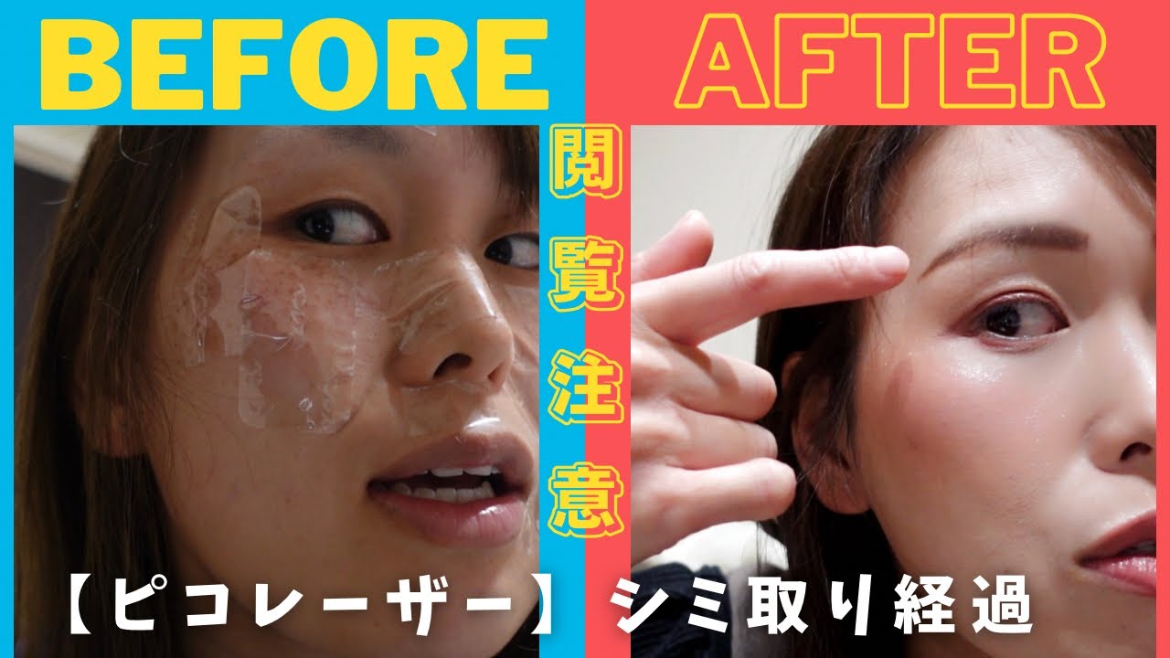 Pico Laser [Pico Spot] Progress Report! - YouTube