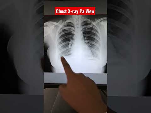 Digital X-ray Chest Pa view Female #shorts #radiography