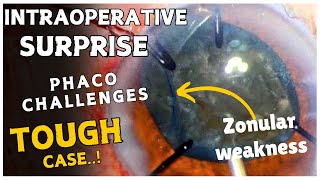 Intraoperative surprises and Phaco challenges in an eye with zonular weakness 