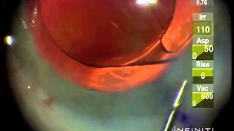 Irrigation Aspiration