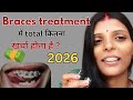 Braces cost in India | braces cost 2026 | type of braces #bracescost #braces #bracesupdate