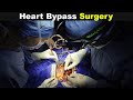 How Does Heart Bypass Surgery Works? | Open Heart Surgery (Urdu/Hindi)