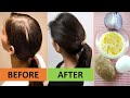 I got FULLER hair after curing my baldness naturally using only 4 ingredients. I applied for 5 days.