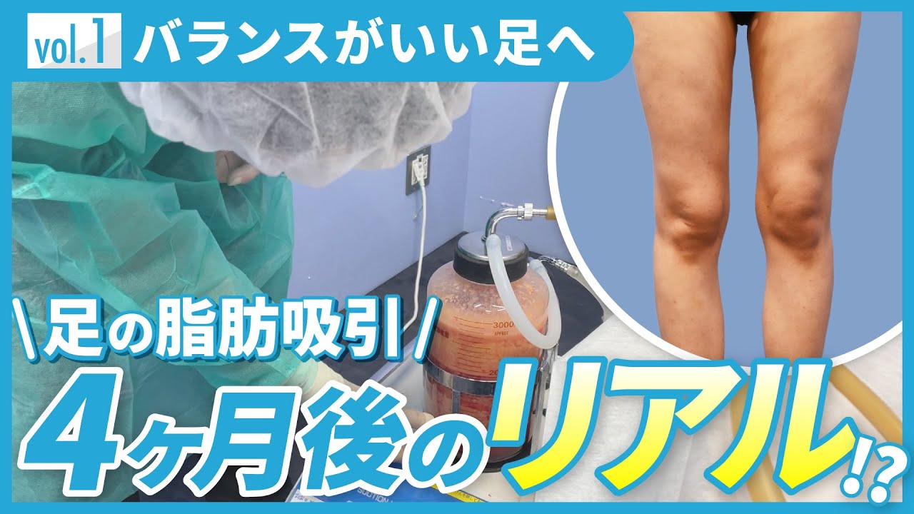 根こそぎ竹田▶︎太もも脂肪吸引【4ヶ月後】仕上がりを大公開！全身の