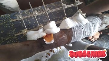 Post Surgical Dressing Procedure Of Internel Fixation | Part 2