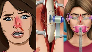 प्लास्टिक नाक सर्जरी ऑपरेशन asmr nose surgery rhinoplasty surgery animation video