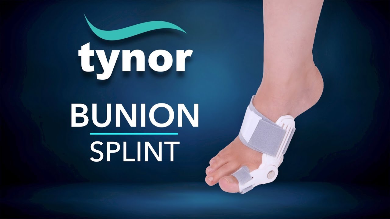 Can A Bunion Splint Help Avoid Bunion Surgery?