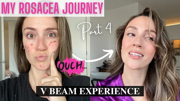ROSACEA JOURNEY PART 4 | V BEAM PRIMA LASER | DAILY PROGRESS UPDATES