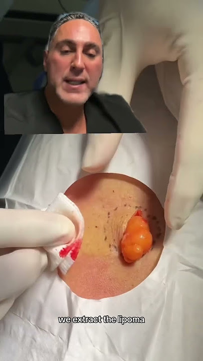 Surgical Removal of a Lipoma