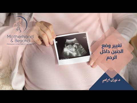 تغيير وضع الجنين داخل الرحم
