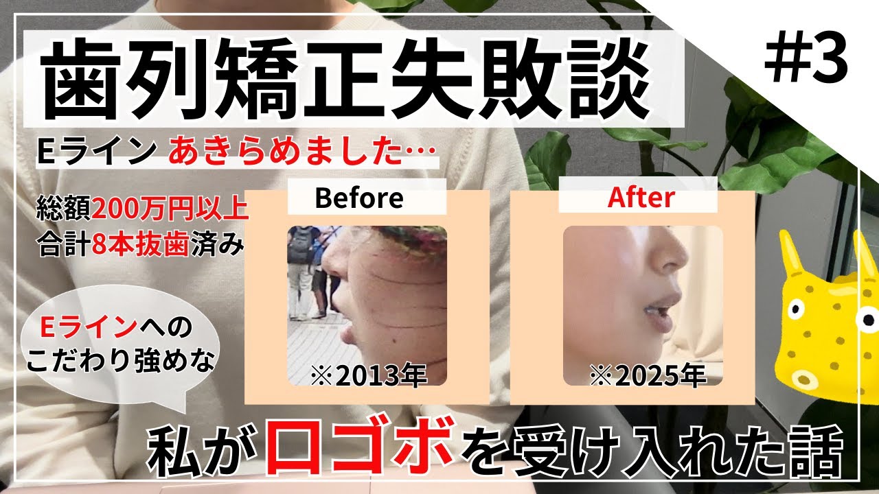 【矯正失敗③】Eラインを諦め、口ゴボを受け入れた話【元インビザライン5年半→現ワイヤー矯正2年目/7年の年月と総額200万円以上費やした女が語る、歯列矯正失敗談】